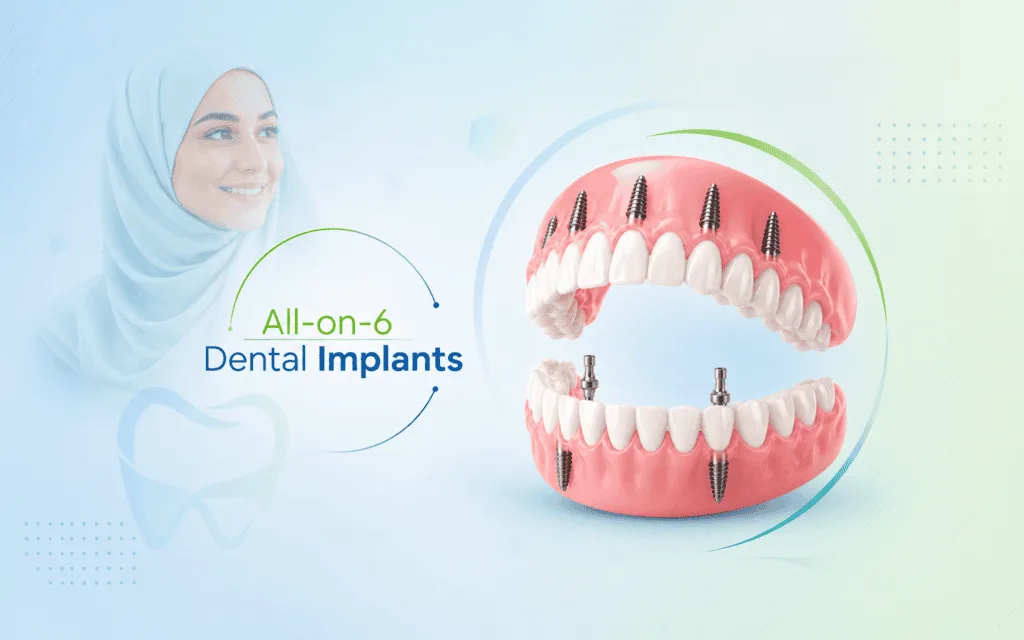 All-on-6 Dental Implants in India