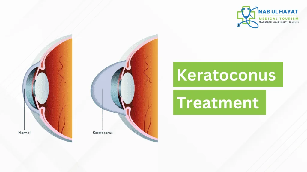 Keratoconus Treatment in India