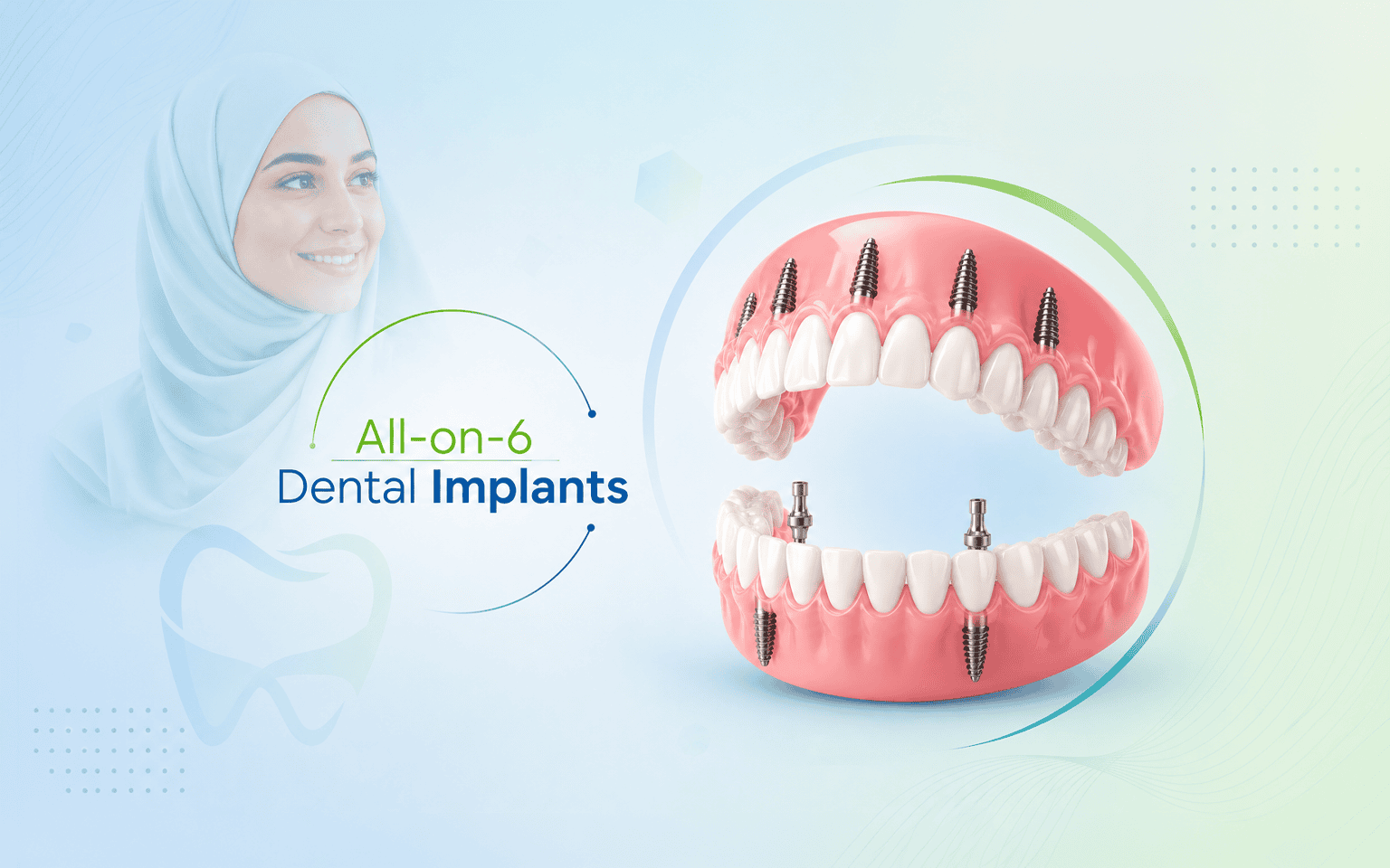 All-on-6 dental implants in India for full mouth restoration