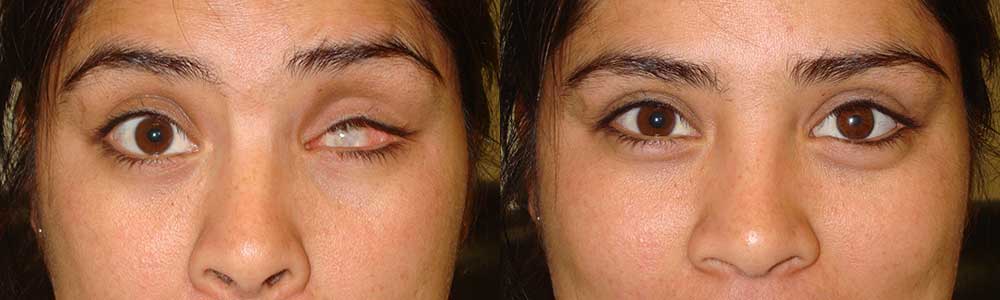 Patient with prosthetic eye: before and after treatment results