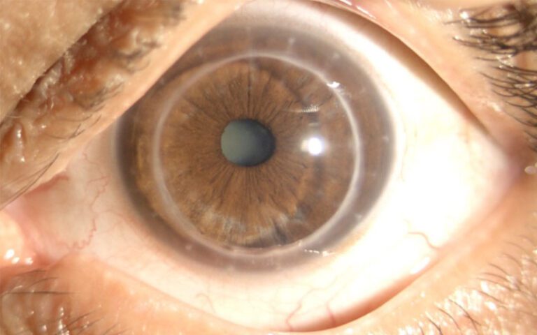 Corneal Transplant Surgery in India