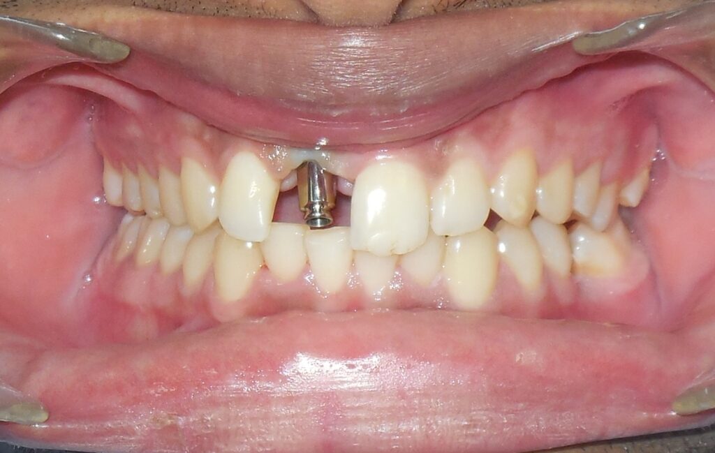 Dental Implants