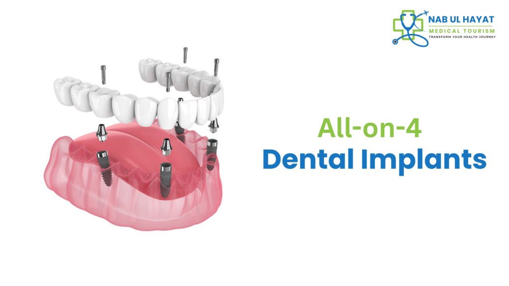 All-on-4 Dental Implants in India