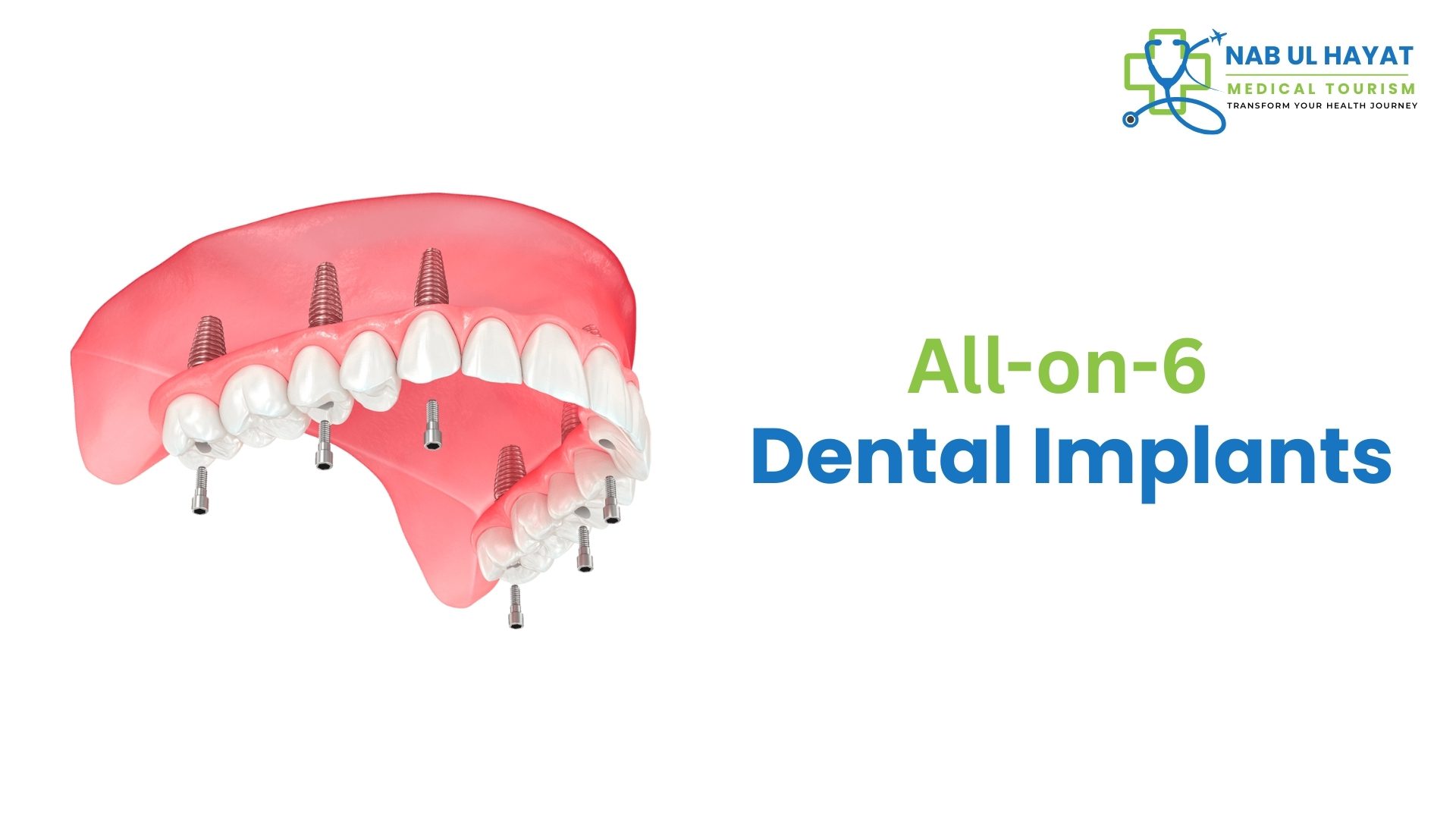 All-on-6 Dental Implants in India