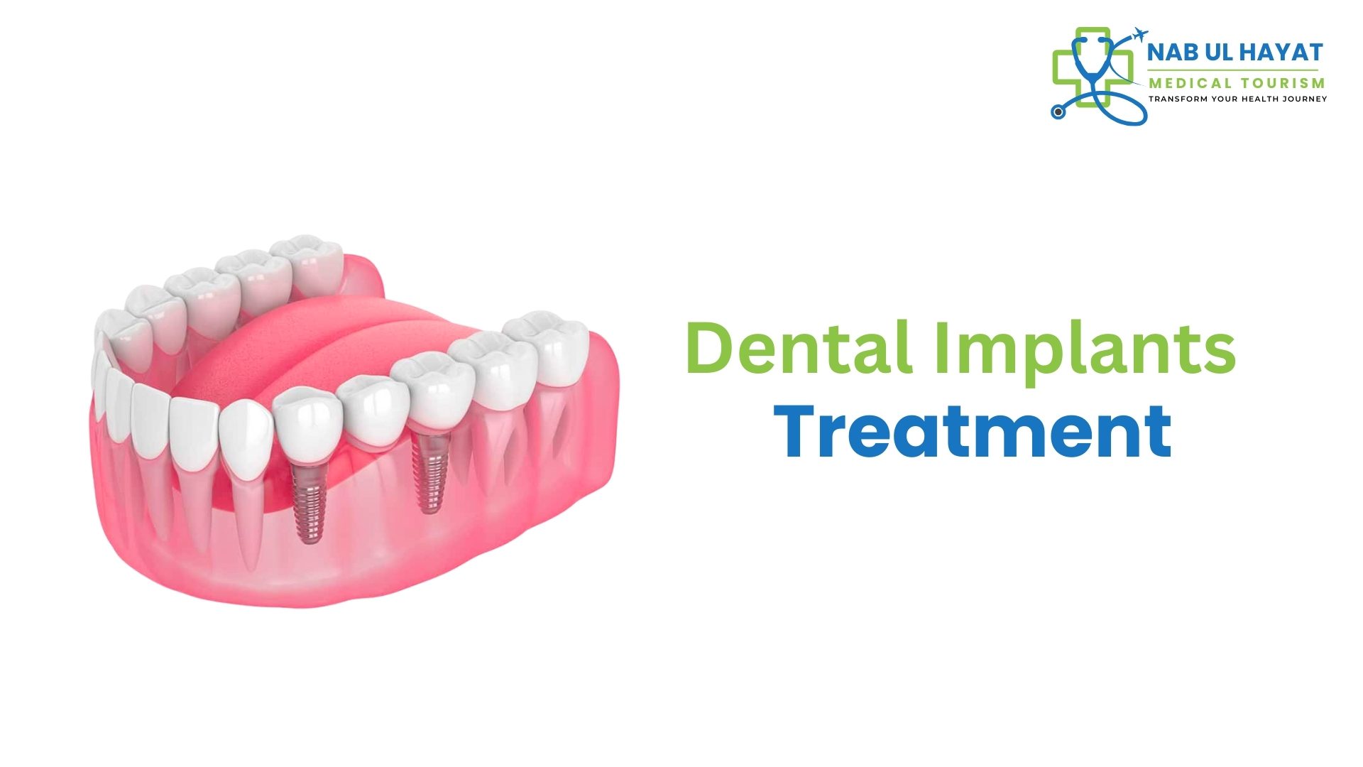 Dental Implants in India