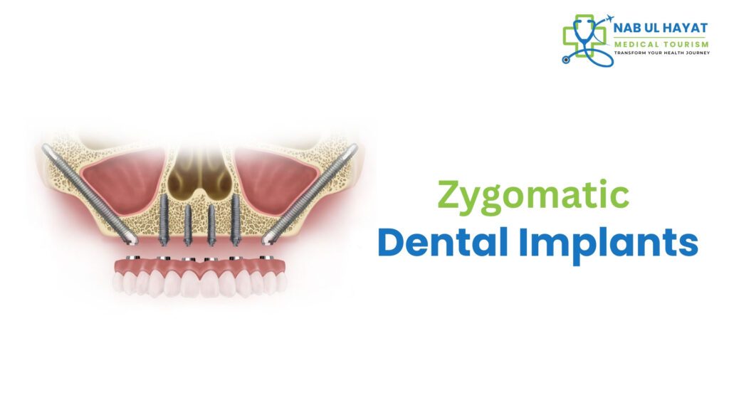 Zygomatic Dental Implant in India