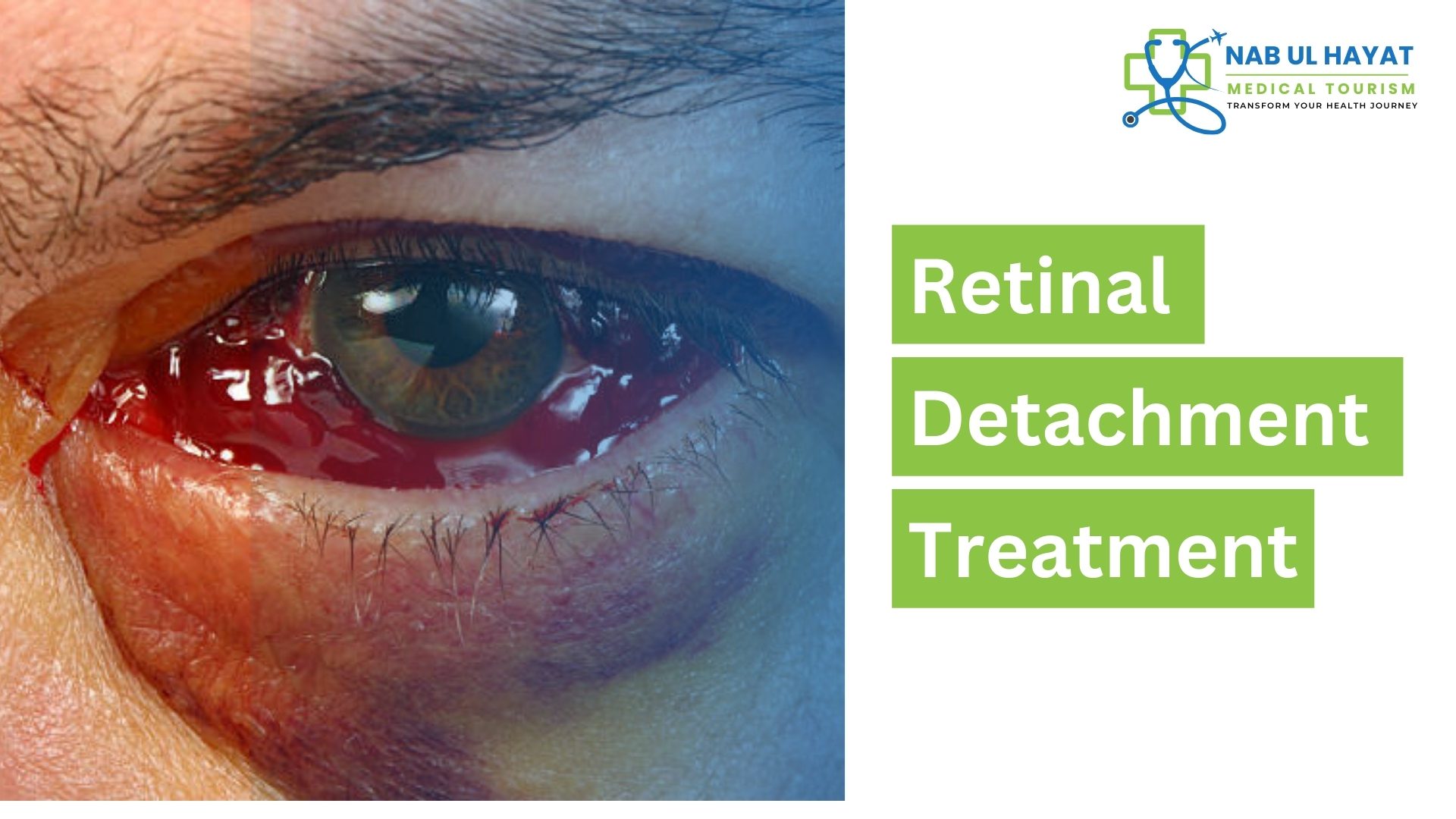 Retinal Detachment