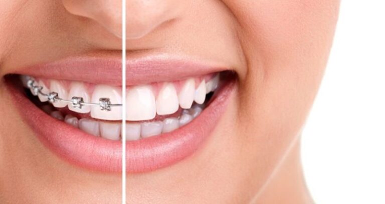Orthodontic Treatment