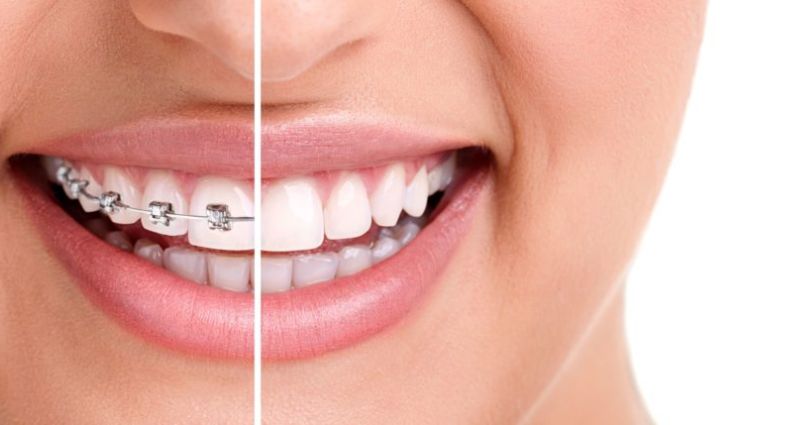Orthodontic Treatment