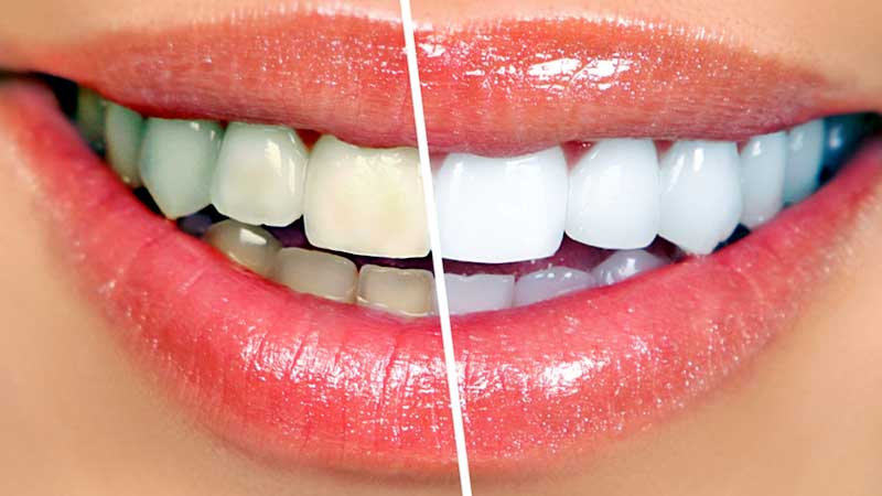 tooth whitening