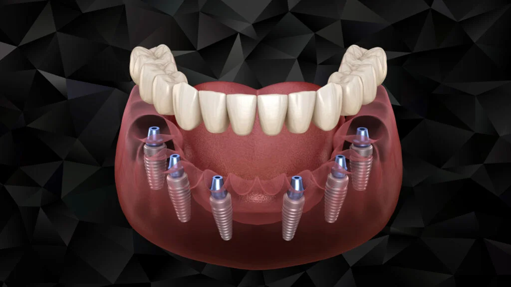 All-on-6 Dental Implants