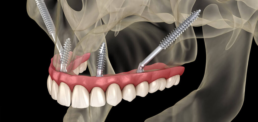 Zygomatic Dental Implants