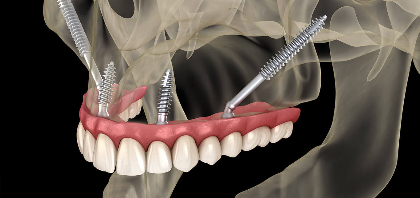 Zygomatic Dental Implants