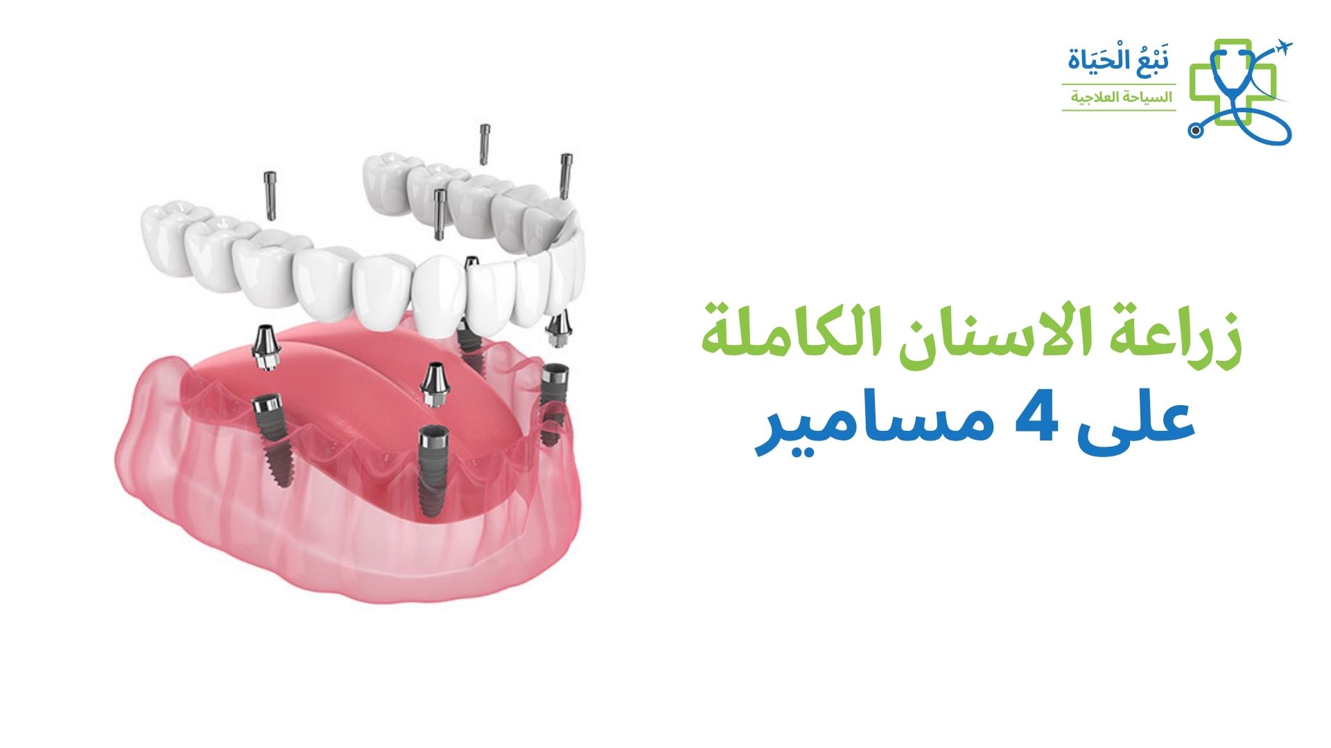 زراعة الأسنان الكل على 4