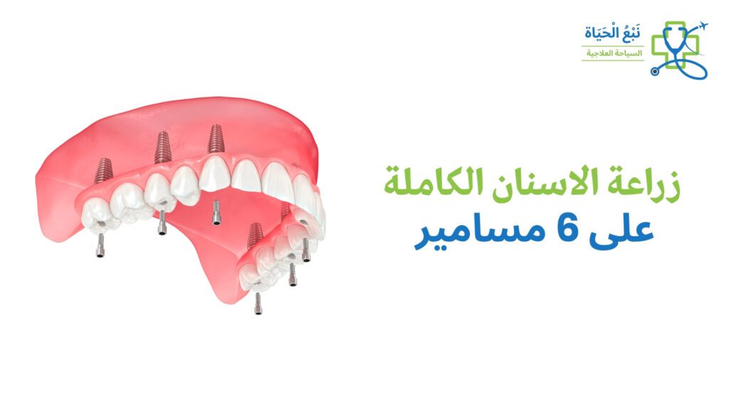 زراعة الأسنان All-on-6