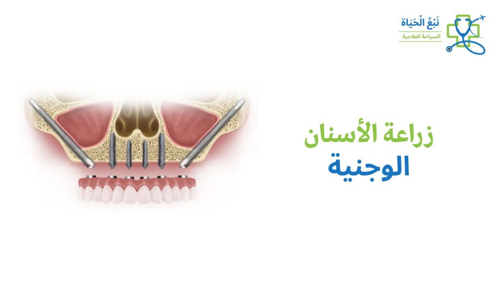 زراعة الأسنان الزيجومية