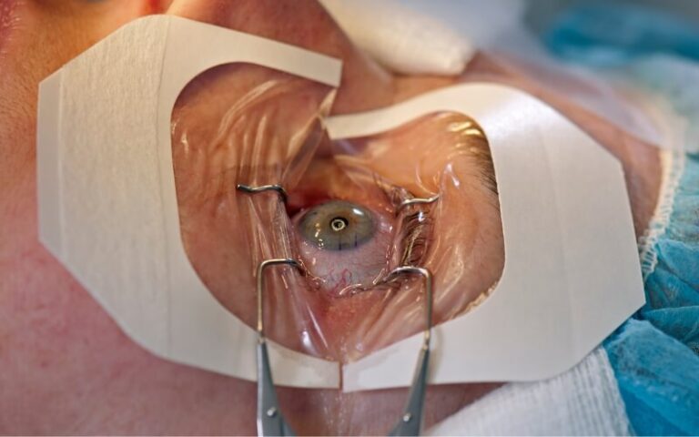 جراحة انفصال الشبكية