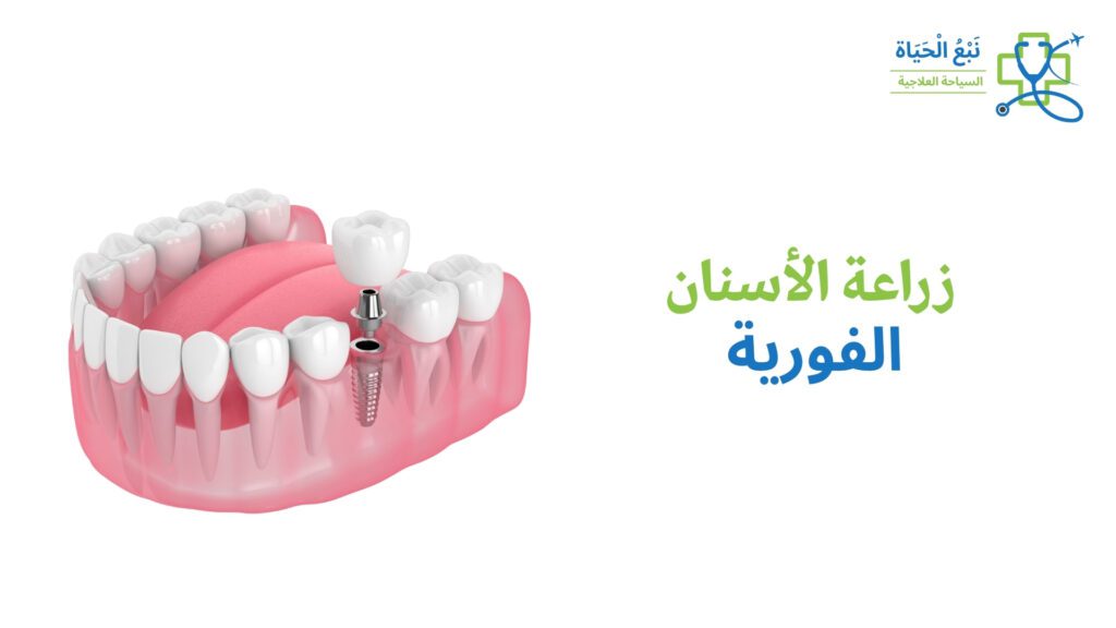 زراعة الأسنان الفورية