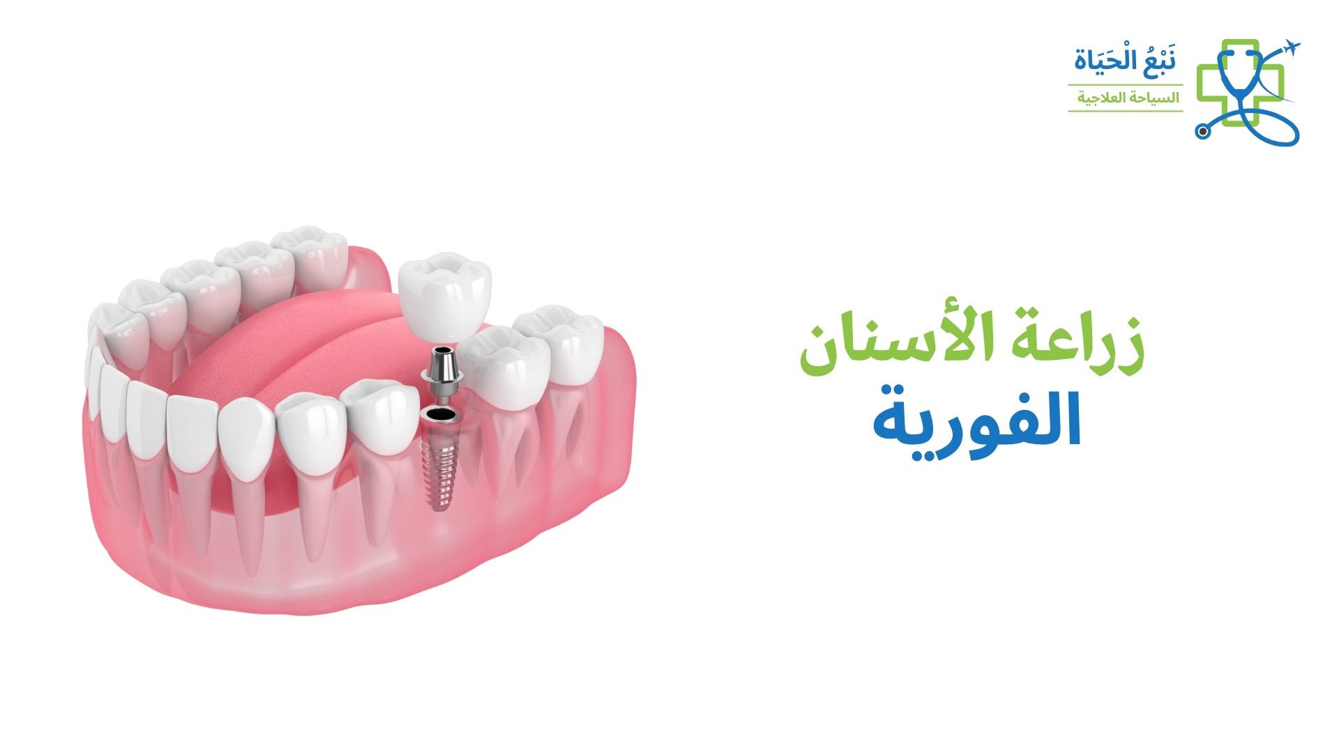 زراعة الأسنان الفورية