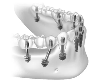 Immediate Dental Implants