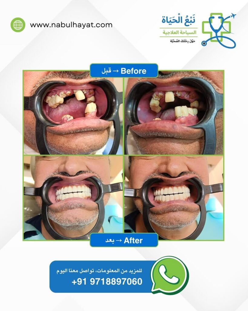 Abu Adil before and After