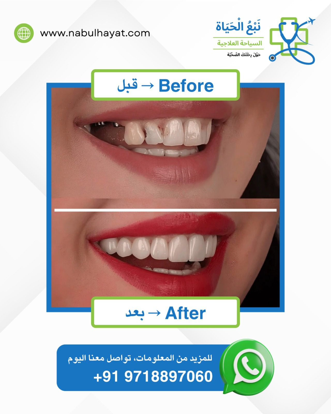 Before vs After Nabul Hayat