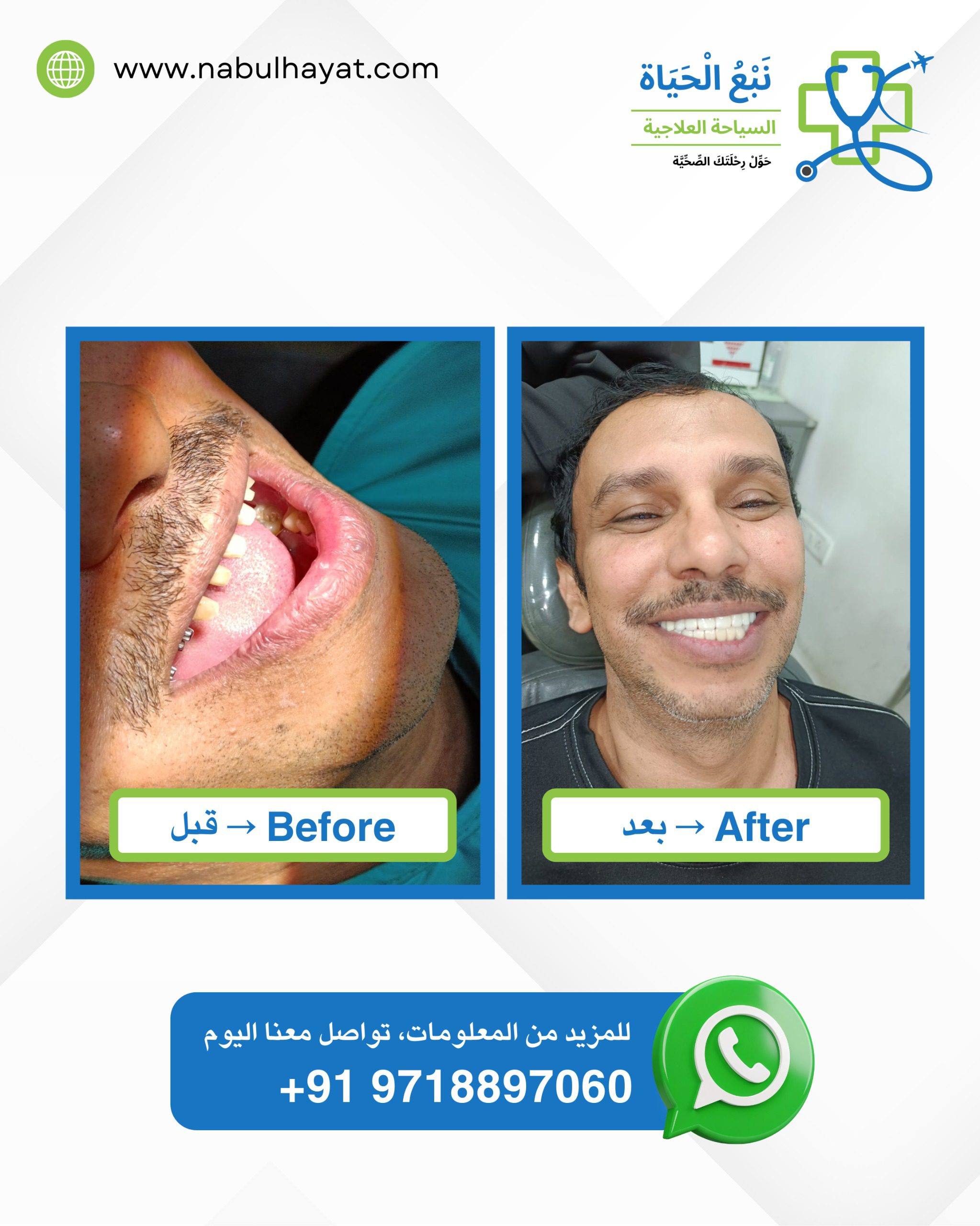 Before vs After Nabul Hayat