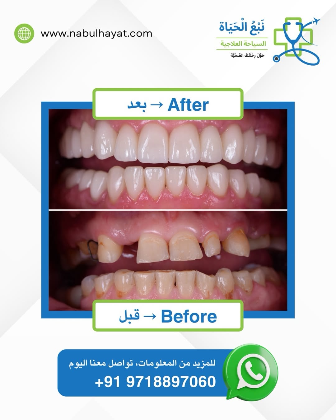 ✨ ابتسامة جديدة تبدأ من هنا! ✨شاهد الفرق المذهل بين قبل و بعد علاج الأسنان مع فريقنا المتخصص في