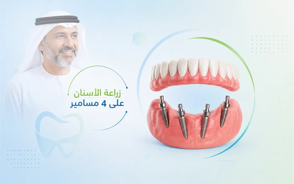 زراعة الأسنان All-on-4 في الهند