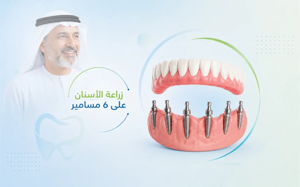زراعة الأسنان All-on-6 في الهند