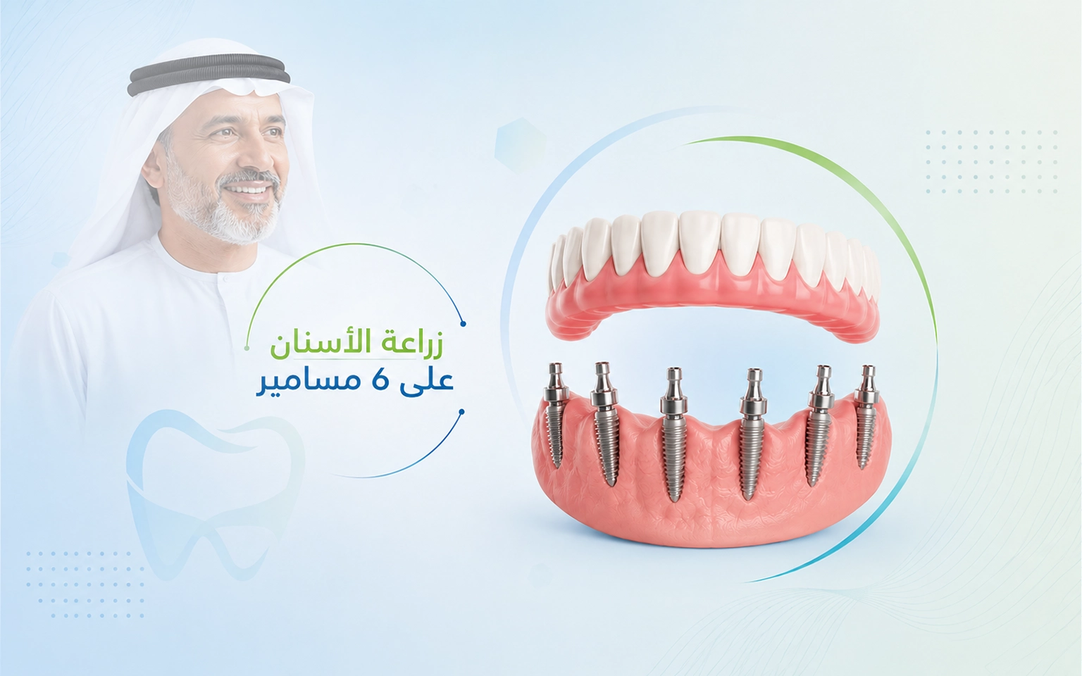 زراعة الأسنان All-on-6 في الهند لاستعادة الفم الكاملة